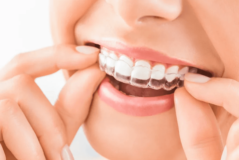 Braces & Aligners