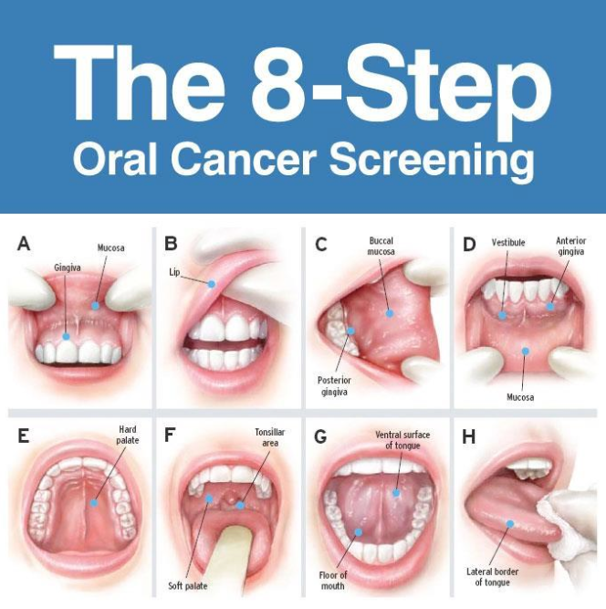 Mouth / Oral Cancer symptoms and treatment - V Dental Care